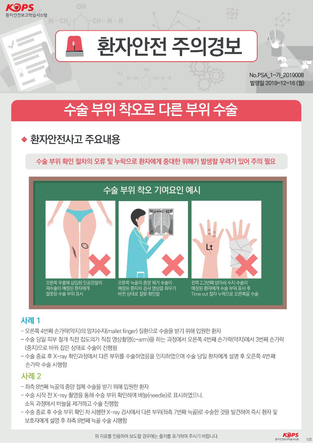 KOPS 환자안전보고학습시스템1 환자안전 주의경보THENERNo.PSA_1-가_2019008 발령일 2019-12-16 (월)수술 부위 착오로 다른 부위 수술◆ 환자안전사고 주요내용수술 부위 확인 절차의 오류 및 누락으로 환자에게 중대한 위해가 발생할 우려가 있어 주의 필요수술 부위 착오 기여요인 예시1881M date드홍오른쪽 무릎에 삽입된 인공관절의 재수술이 예정된 환자에게 잘못된 수술 부위 표시오른쪽 늑골의 종양 제거 수술이 . 예정된 환자의 검사 영상을 좌우가 바뀐 상태로 잘못 확인함.왼쪽 2,3번째 방아쇠 수지 수술이 예정된 환자에게 수술 부위 표시 후 Time out 절차 누락으로 오른쪽을 수술사례 1 - 오른쪽 4번째 손가락(약지)의 망치수지(mallet finger) 질환으로 수술을 받기 위해 입원한 환자 - 수술 당일 피부 절개 직전 집도의가 직접 영상촬영(carm)을 하는 과정에서 오른쪽 4번째 손가락(약지)에서 3번째 손가락(중지)으로 바꿔 잡은 상태로 수술이 진행됨 - 수술 종료 후 X-ray 확인과정에서 다른 부위를 수술하였음을 인지하였으며 수술 당일 환자에게 설명 후 오른쪽 4번째손가락 수술 시행함 사례 2 - 좌측 8번째 늑골의 종양 절제 수술을 받기 위해 입원한 환자 - 수술 시작 전 X-ray 촬영을 통해 수술 부위 확인하며 바늘(needle)로 표시하였으나,소독 과정에서 바늘을 제거하고 수술 진행함 - 수술 종료 후 수술 부위 확인 차 시행한 X-ray 검사에서 다른 부위(좌측 7번째 늑골)로 수술한 것을 발견하여 즉시 환자 및 보호자에게 설명 후 좌측 8번째 늑골 수술 시행함| 위 자료를 인용하여 보도할 경우에는 출처를 표기하여 주시기 바랍니다.KOPS 환자안전보고학습시스템1/3